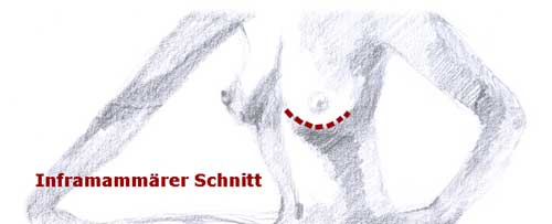 Unterbrustfalte Mammaaugmentation